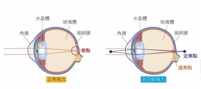 白內(nèi)障和老花眼區(qū)別，老花眼發(fā)病率正呈現(xiàn)年輕化趨勢(shì)